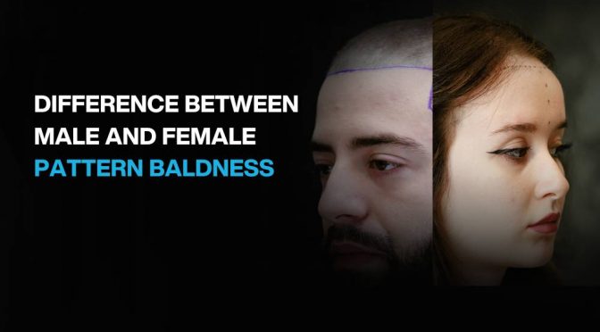 Difference Between Male and Female Pattern Baldness