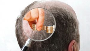 Factors affecting hair transplant cost in Turkey
