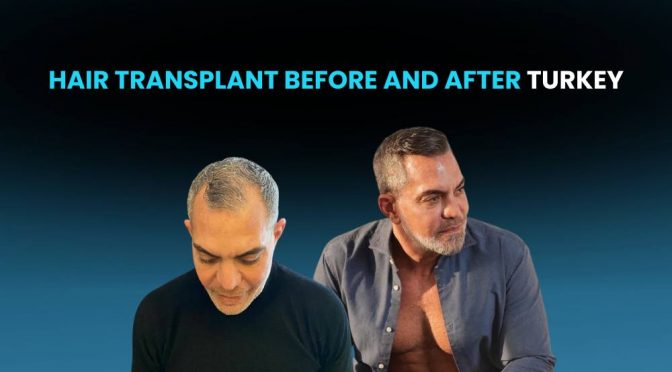 hair transplant before and after turkey