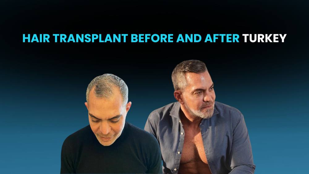hair transplant before and after turkey