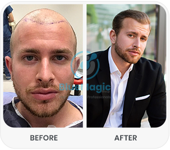 Side-by-side comparison highlighting the transformation after a hair transplant procedure. The left side features a 'Before' image showing complete baldness on the scalp, while the right side presents an 'After' image with restored, natural-looking hair growth styled professionally.