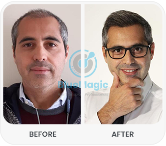 Side-by-side comparison showing the results of a hair transplant procedure performed by BlueMagic Group. The 'Before' image features a man with visible hair thinning, while the 'After' image highlights a fuller, natural-looking head of hair, achieved through advanced techniques like DHI (Direct Hair Implantation).