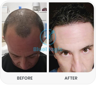 Before and after images showcasing the results of a hair transplant procedure performed by BlueMagic Group Clinic. The 'before' image highlights significant hair thinning and visible scalp, while the 'after' image demonstrates a successful restoration with fuller, natural-looking hair growth. 