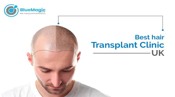 Leading San Francisco Bay Area Robotic Hair Transplant Clinic, Silicon  Valley Hair Institute Releases New Video - Miguel Canales M.D.