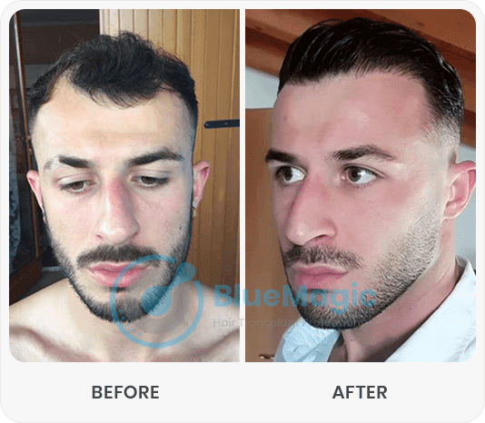 Hair Transplant Turkey Istanbul BlueMagic Group