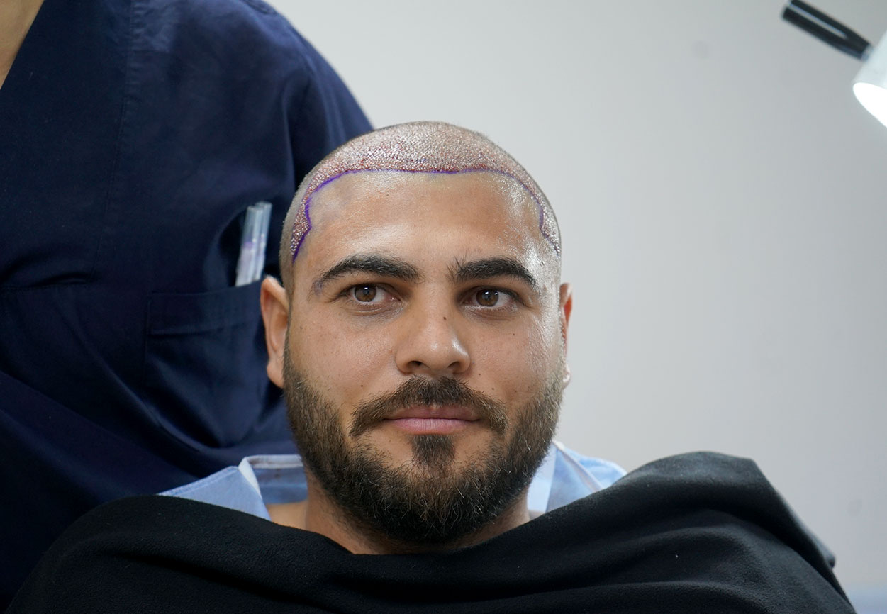 fue transplant advanatages