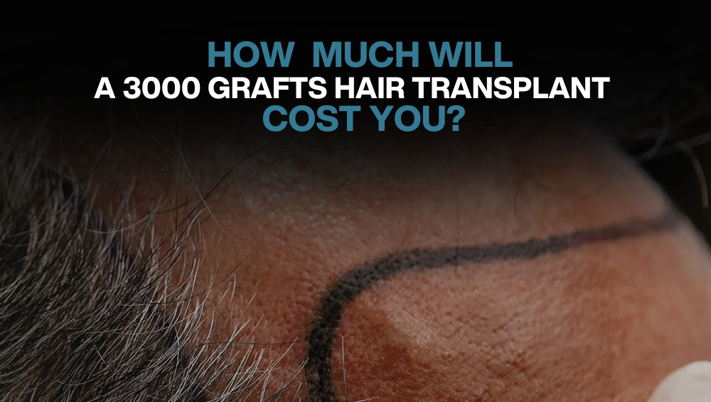 3000 Grafts Hair Transplant  Operation  Cost in 2023  Heva Clinic