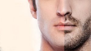 Close-up of a patient’s scalp during the initial stages of a hair transplant procedure, highlighting the precision of follicle extraction and implantation techniques.