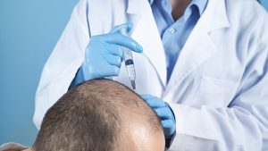 Medical team performing a hair transplant procedure at BlueMagic Group, showcasing teamwork and expertise in restoring natural hairlines