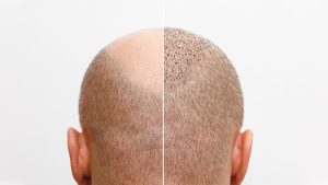 Patient consultation for a hair transplant procedure at BlueMagic Group, focusing on personalized treatment plans and expected results.