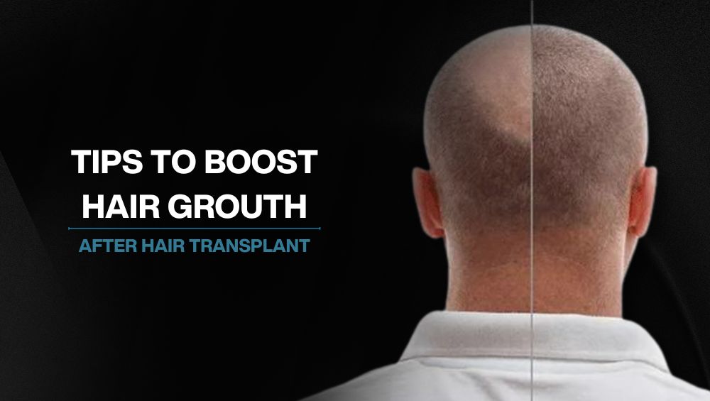 Tips to Boost Hair Growth After A Hair Transplant