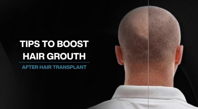 Tips to Boost Hair Growth After A Hair Transplant
