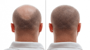 Hair growth pattern after hair transplant