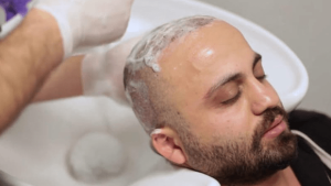 Hair wash process after hair transplant