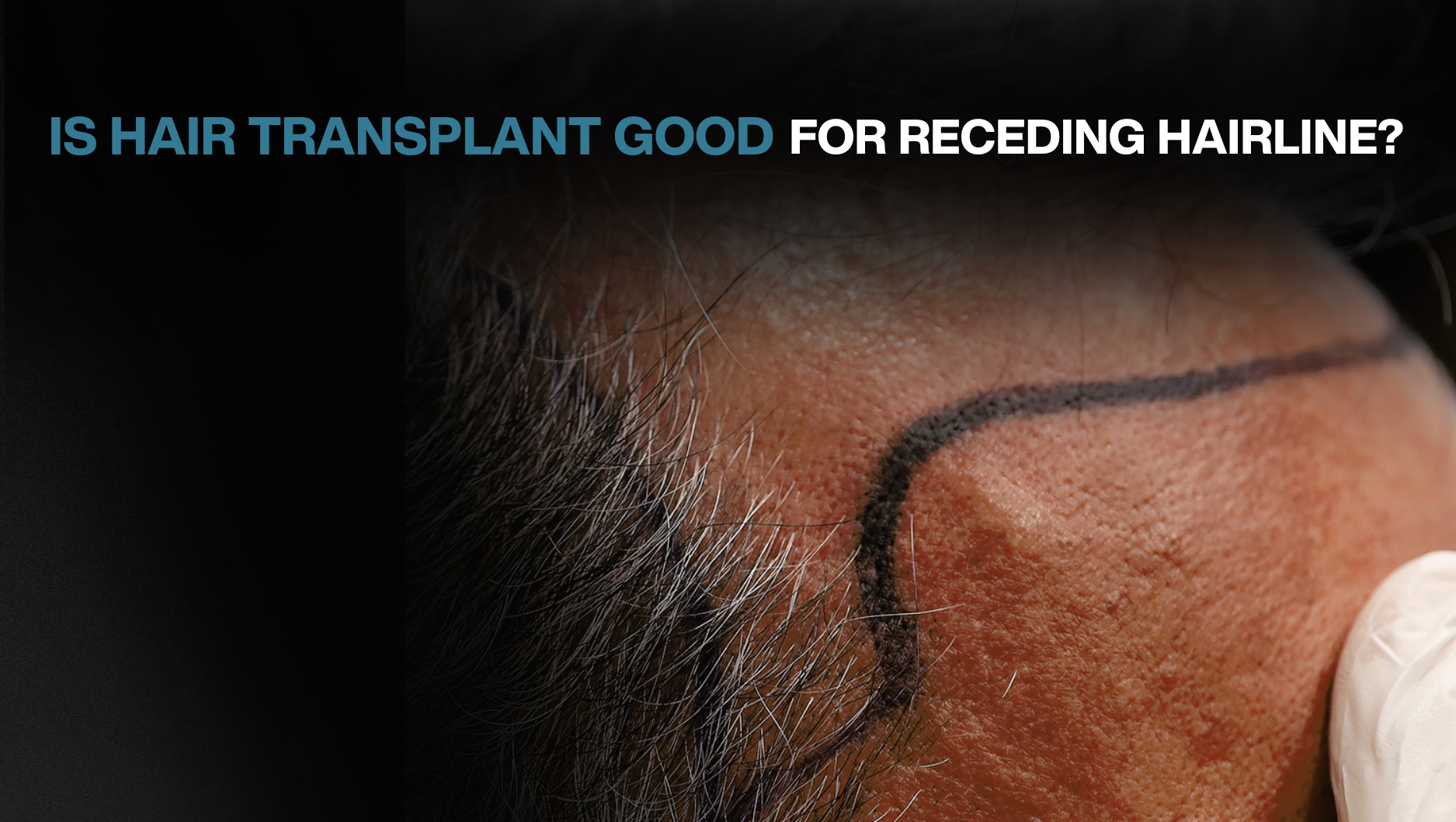 Is Hair Transplant Good for Receding Hairline? - BlueMagic Group
