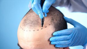 What to Expect After a Hair Transplant Surgery?