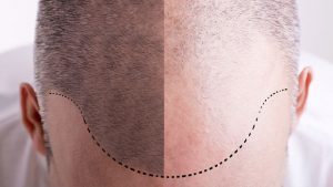 Top 12 Benefits Of A Hair Transplant Surgery