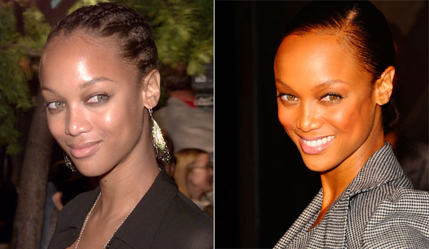 tyra banks hair transplant