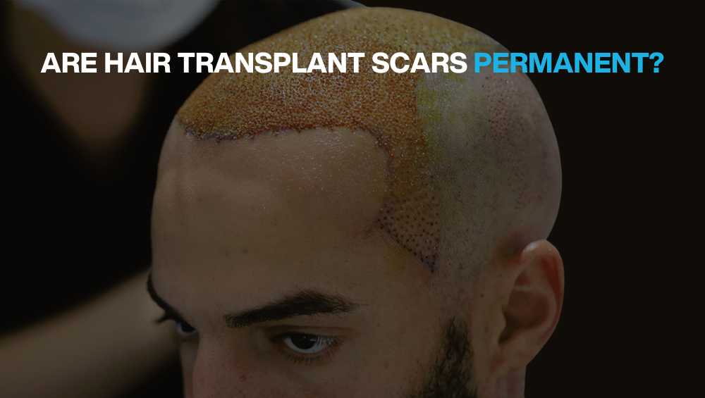 Are Hair Transplant Scars Permanent? - BlueMagic Group
