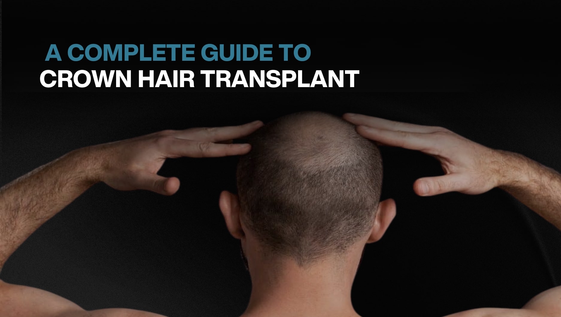 A Complete Guide To Crown Hair Transplant - BlueMagic Group