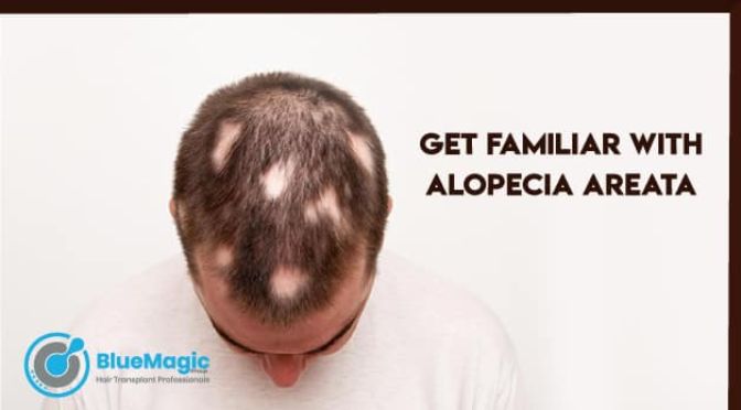 Is Hair Transplant An Effective Treatment For Alopecia Areata?