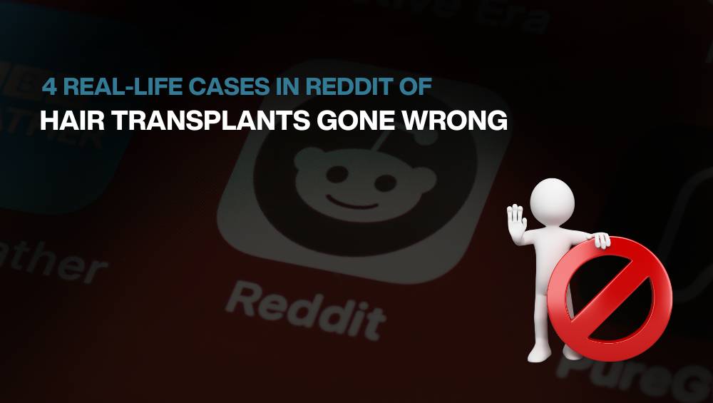 Reddit cases of Hair Transplants Gone Wrong - BlueMagic Group
