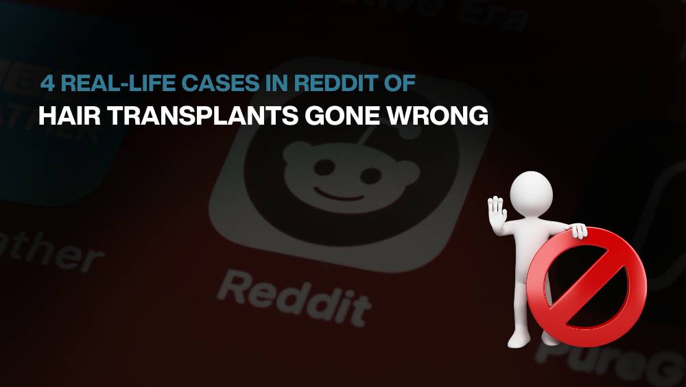 Reddit cases of Hair Transplants Gone Wrong - BlueMagic Group Reddit cases of Hair Transplants Gone Wrong - BlueMagic Group