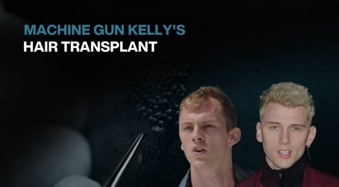 Copy of Hair transplant for Women