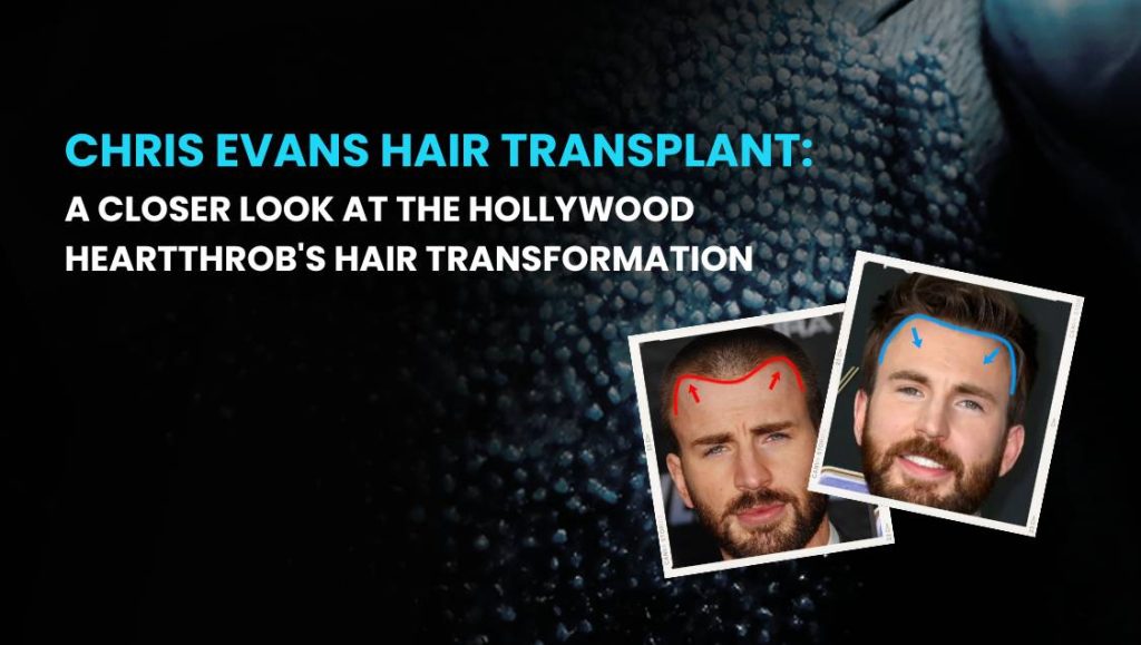 Chris Evans Hair Transplant