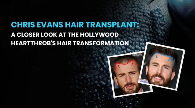 Chris Evans Hair Transplant
