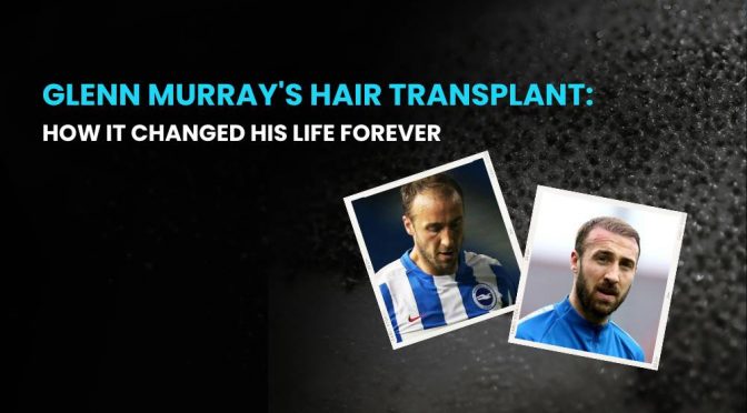 Glenn Murrays Hair Transplant