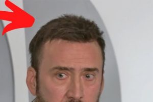 Nicolas Cage's Hair Transplant | BlueMagic Group Clinic