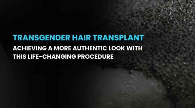 Transgender Hair Transplant: Achieving a More Authentic Look with this Life-Changing Procedure