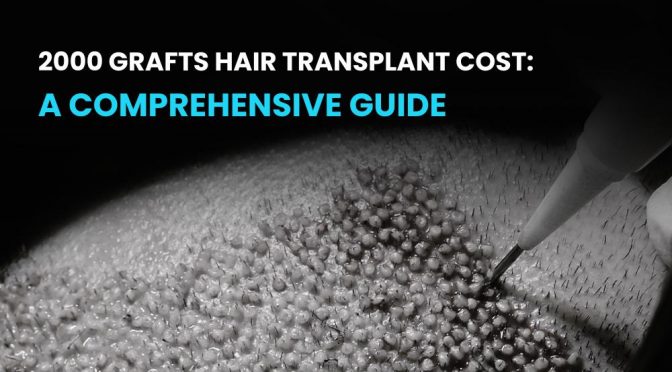 2000 Grafts Hair Transplant Cost: A Comprehensive Guide