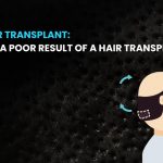 Bad Hair Transplant What Is a Poor Result of a Hair Transplant