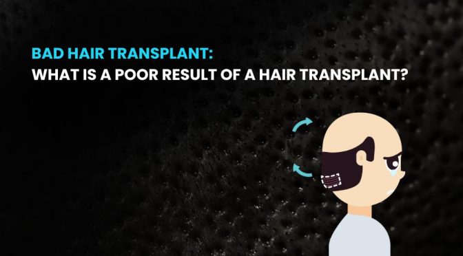 Bad Hair Transplant: What Is a Poor Result of a Hair Transplant?