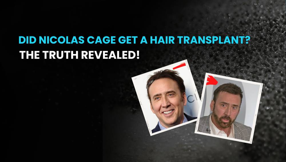 Did Nicolas Cage Get a Hair Transplant The Truth Revealed
