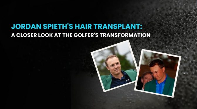 Jordan Spieth Hair Transplant 1