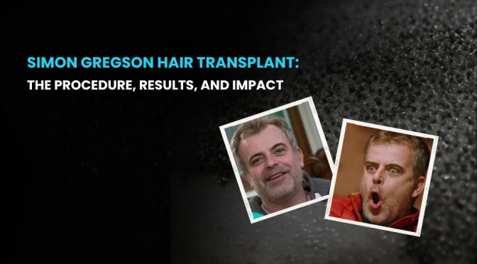 Simon Gregson Hair Transplant 