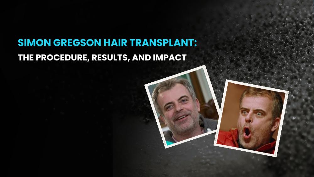 Simon Gregson Hair Transplant