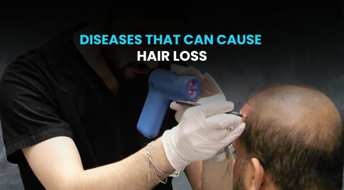 Diseases That Can Cause Hair Loss