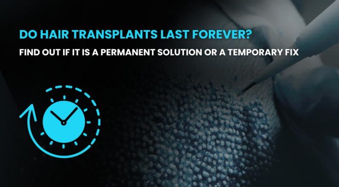 Do hair transplants last forever
