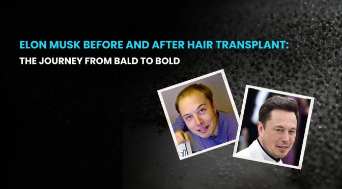 Elon Musk Before and After Hair Transplant 