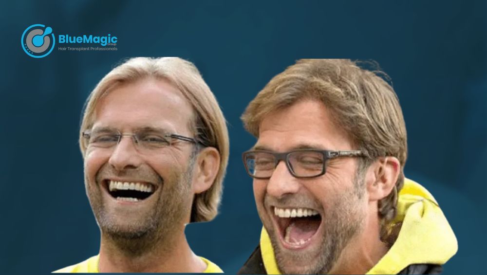 Jurgen Klopp Hair Transplant - Before and After