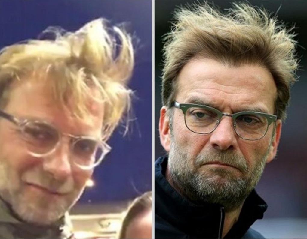 Jurgen klopp hair transplant before and after 