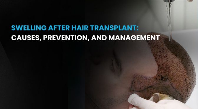 Swelling After Hair Transplant 