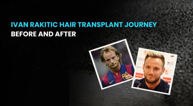 Ivan Rakitic Hair Transplant journey