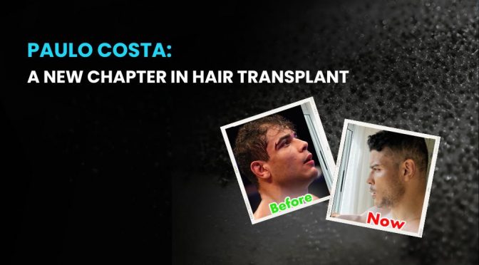 Paulo Costa Hair Transplant