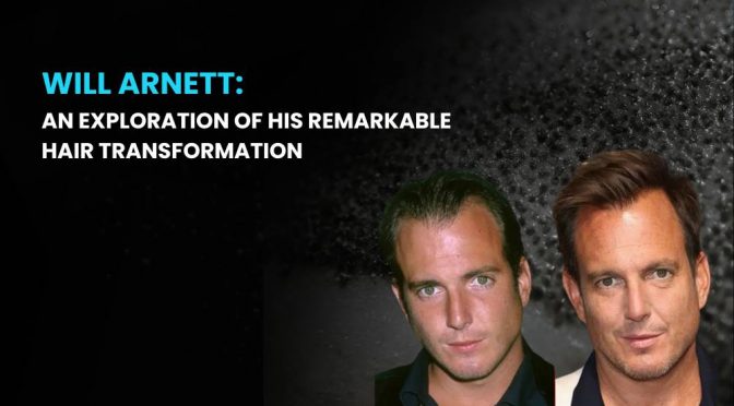 Will Arnett Hair Transplant