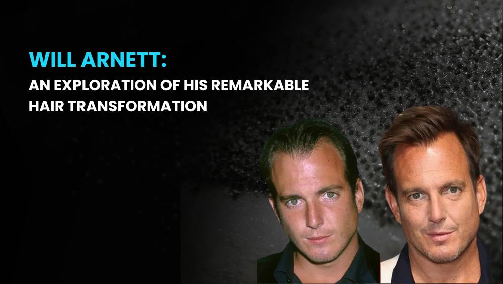 Will Arnett Hair Transplant